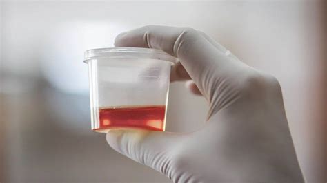 What Causes Blood In Urine Hematuria Everyday Health