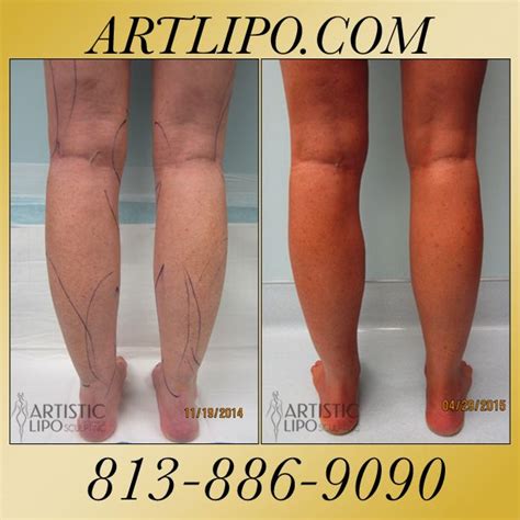 Cankles Ankles Calves And Knees Are Areas That Many Women Arent Aware That Liposuction