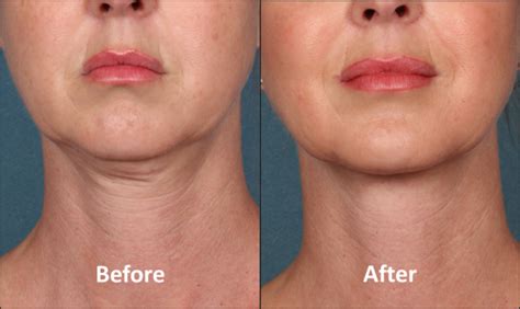 Grossman Plastic Surgery Facial Aesthetics Certified To Offer Kybella