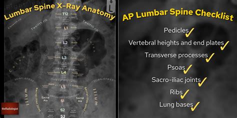 Lumbar Spine X Ray Anatomy And Interpretation Checklist Grepmed