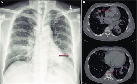 Chest X Ray A Showed Left Lower Lobe Lung Nodule CT Scan B Download Scientific Diagram