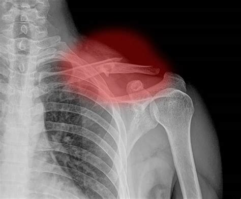 Broken Collar Bone Stock Photos Pictures And Royalty Free Images Istock