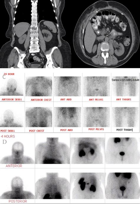 A Coronal View Of CT Abdomen ABD And Pelvis Without Contrast