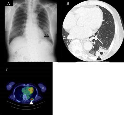 Abnormal Shadow On Chest Radiograph Medpage Today