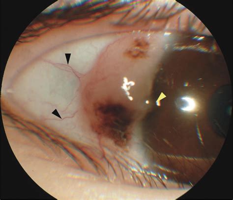 Conjunctival Balloon Cell Nevus In A Young Child A Case Report