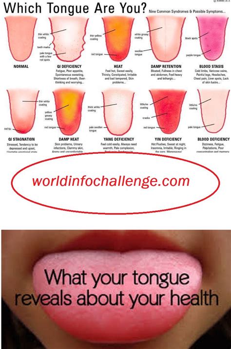 What Your Tongue Says About Your Health Health Natural Headache