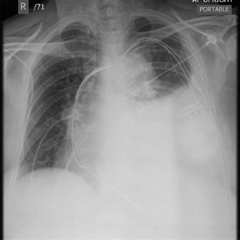 Chest X Ray Taken In The Emergency Department Prior To Hospital