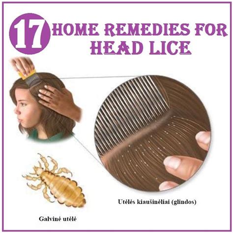 Home Remedies For Head Lice You Never Know When This Info Might Come