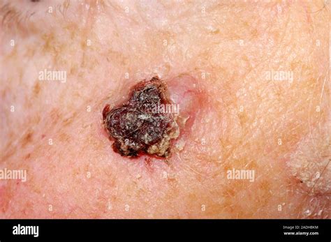 Basal Cell Carcinoma BCC Or Rodent Ulcer On An Year Old Woman S Cheek This Is The Most