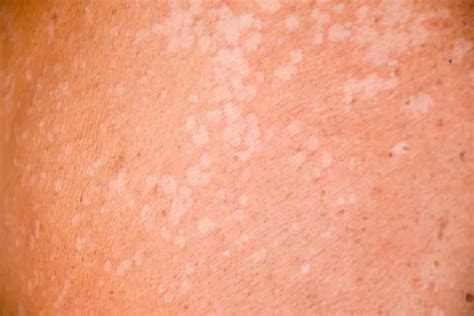 Tinea Versicolor Signs Causes And Treatments Activebeat Your