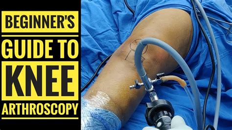 Beginners Guide To Knee Arthroscopy An Excellent Video For All