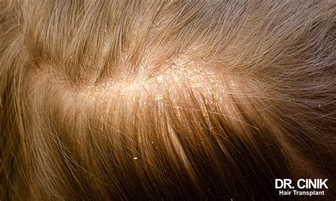 scabs and soreness on the scalp 11 1 reasons