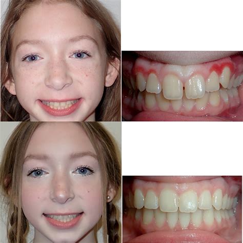 Braces Before And After Smile