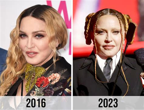 Madonna Looks Unrecognizable Now A Plastic Surgeon Weighs In