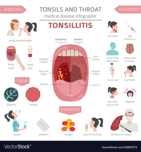 Diagram Of Tonsils And Throat
