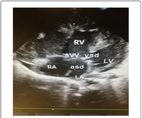 C Transthoracic 2 Dimensional Echocardiogram In Apical 4 Chamber View