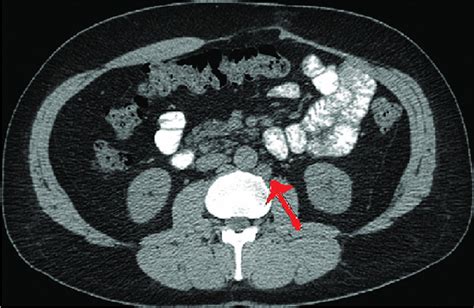 Computed Tomography Scan Of Chest Abdomen And Pelvis Showing Enlarged