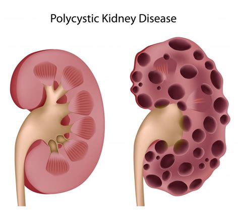 What Are The Different Types Of Kidney Mass With Pictures