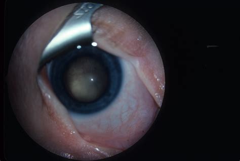 Retinoblastoma Hereditary Ocular Diseases