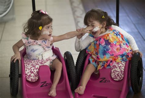 California Conjoined Twins 2 Who Were Separated Thrive At Home