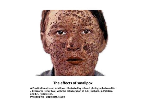 Smallpox Definition