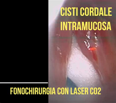 Cisti Intracordale Fonochirurgia Con Laser Co2 Prof Maurizio Vigili