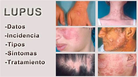 Tipos De Lupus Causas Síntomas Y Tratamiento