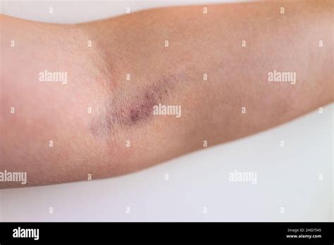 Woman Bruising Arm Hi Res Stock Photography And Images Alamy