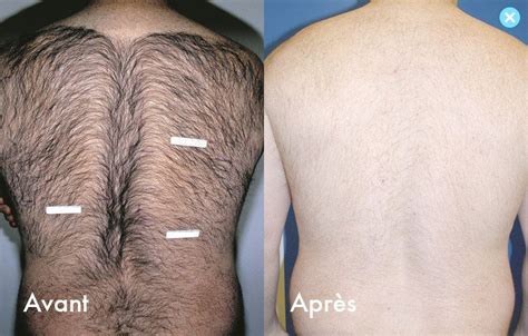 Epilation Laser Photo Avantaprès Laser Hair Treatment Hair Removal Laser Tattoo Removal