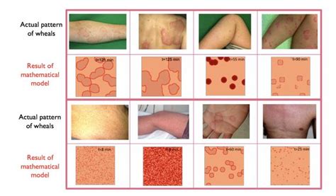 It is more common in boys and rarely, it can be linked to other associated medical problems. Studying the geometry of a common skin disease ...