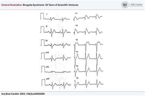 Brugada Syndrome 30 Years Of Scientific Ventures Abc Cardiol