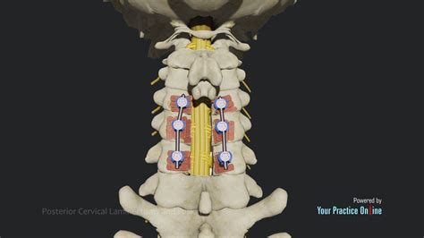 Posterior Cervical Laminectomy And Fusion Video Medical Video Library