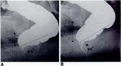 Defecogram Shows Spastic Pelvic Floor Syndrome In 66 Year Old Man With Download Scientific