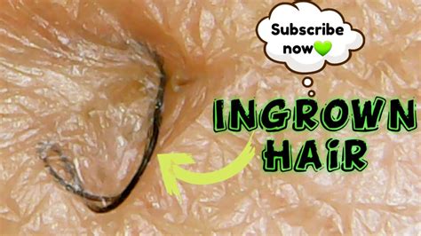 Ingrown Hair Removal On The Groin Inguinal Short Video Youtube
