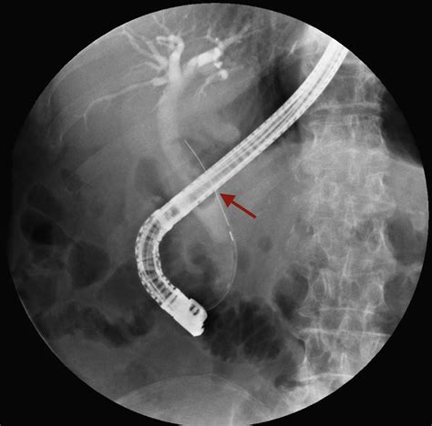 Ercp Fluoroscopic Image Showing A Large Biliary Stone 15 Cm Arrow