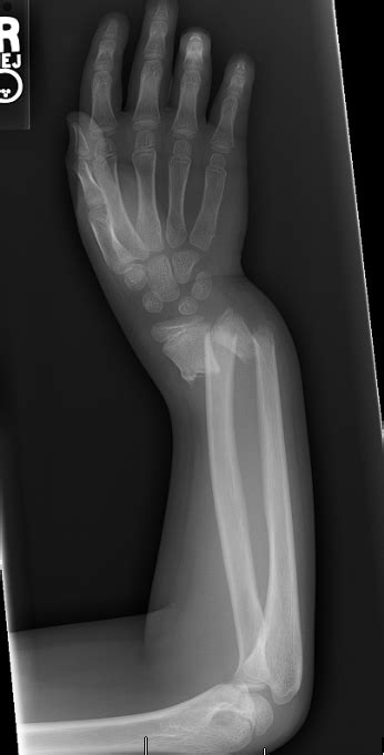 Forearm Fractures In Kids What Parents Need To Know