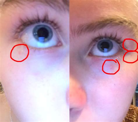 Skin Concerns Strange Small Spots Around Eyes Skincareaddiction