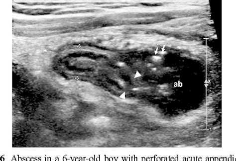 Ultrasound Of The Pediatric Appendix Semantic Scholar