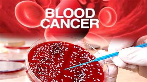 Blood Cancer Signs And Diagnosis Successyeti