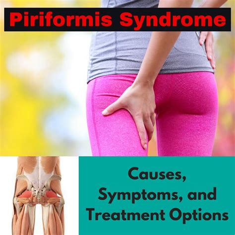 Breaking Down Piriformis Syndrome Causes Symptoms And Treatment Opt Orthorelieve