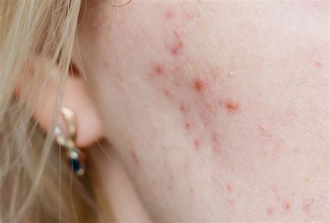 Cystic Acne Causes Symptoms Medical Treatment