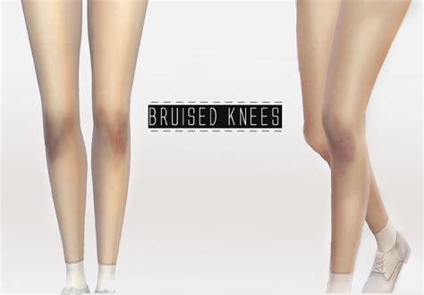 Bruised Knees Sims 4 Sims 4 Cc Sims