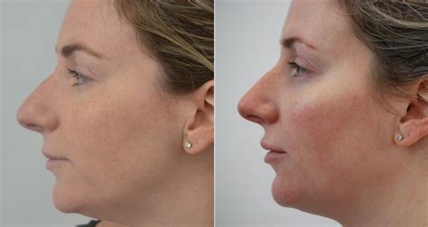 Dermal Fillers Before And After Photos The Plastic Surgery Clinic