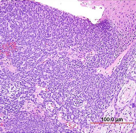 Squamous Cell Carcinoma In Situ Histology