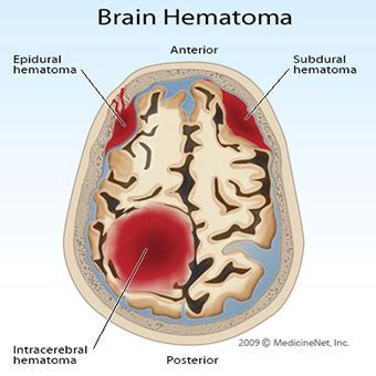 Epidural hematoma brain injuries (also referred to as extradural hemorrhages) involve blood. What Is a Hematoma? Subdural, Epidural, Treatment & Types