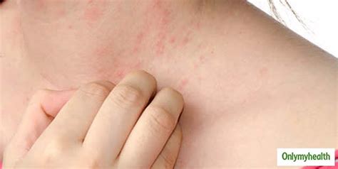 Heat Rash In Kids Try These Effective Natural Treatments For Relief