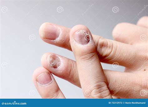 Fungus Infection On Nails Hand Finger With Onychomycosis Soft Focus