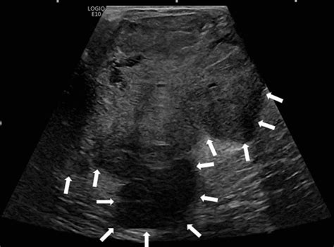 Cureus Giant Phyllodes Tumor In An 82 Year Old Female Initially