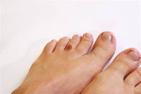 Detect Types Of Skin Cancer On Your Feet Austin Foot And Ankle