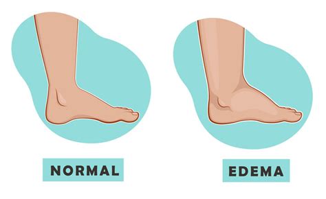 Swollen Feet 8 Common Causes And Solutions • Sensational Feet